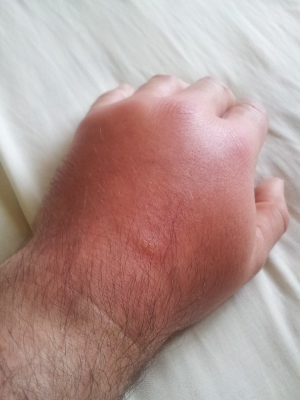 horsefly bite