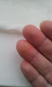 finger wear and tear